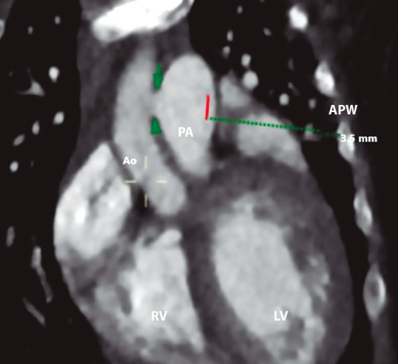 Percutaneous closure of aortopulmonary window using a muscular ventricular septal defect occluder. Instituto Nacional de Salud del Niño San Borja Lima-Peru. Case report.