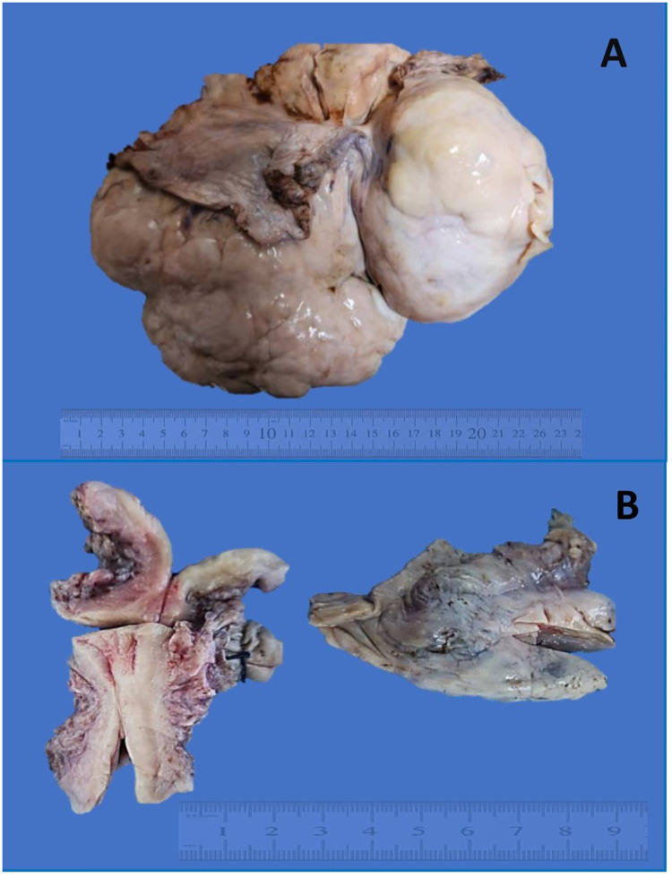 Navigating Ambiguous Genitalia: A Case of Dysgerminoma in an Afghan Boy.
