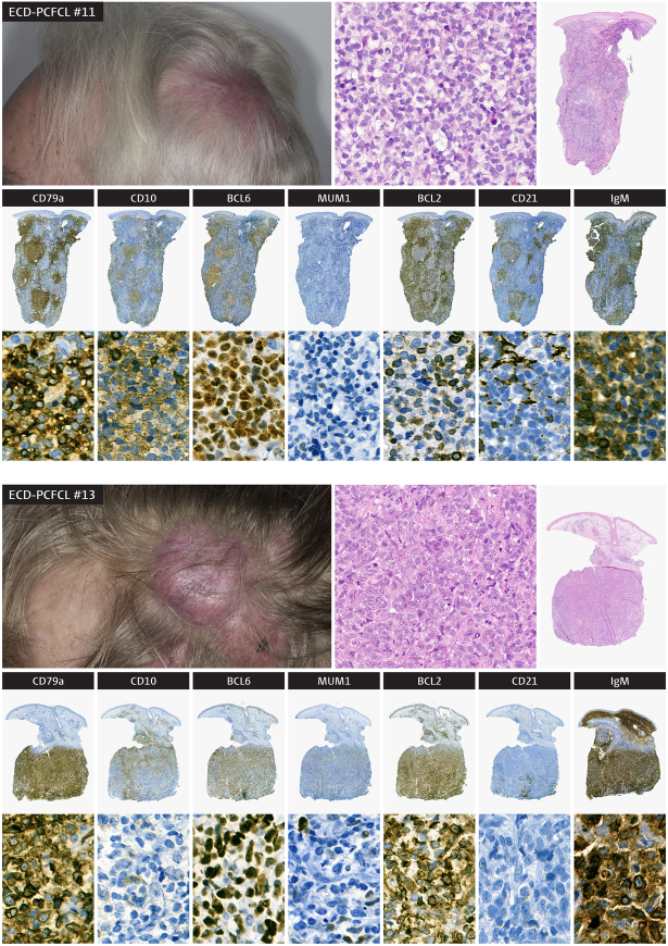 IgM Immunohistochemical Expression is a Potential Risk Factor for Extracutaneous Dissemination in Patients With Primary Cutaneous Follicle Center Lymphoma.