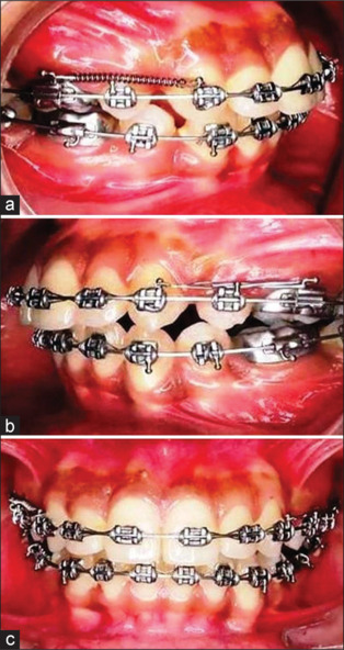 Evaluation and comparison of microbial colonization on nickel titanium (NiTi) closed coil springs and active tie-backs during orthodontic space closure: An <i>in-vivo</i> study.