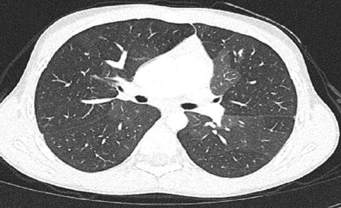 The Role of Pulmonary Genetic Variations in the Pathogenesis of Pediatric Postinfectious Bronchiolitis Obliterans.