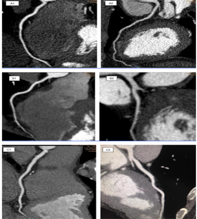 Optimization of Retrospective Gated-ECG Coronary Computed Tomography Angiography by Dose Reduction in Patients with Different Body Mass Indexes.