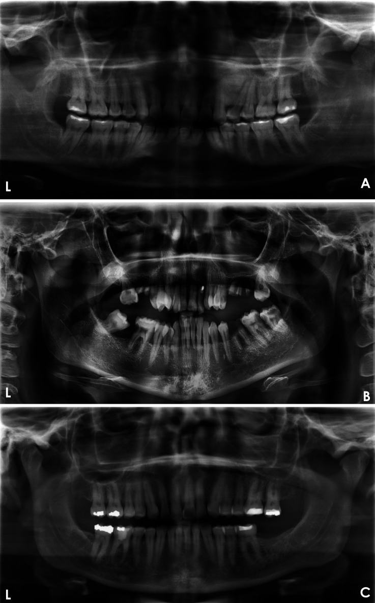 Automated quality evaluation of dental panoramic radiographs using deep learning.
