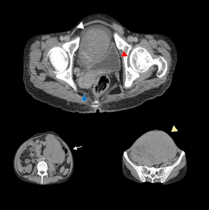 Navigating Ambiguous Genitalia: A Case of Dysgerminoma in an Afghan Boy.
