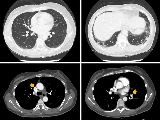 Anti-OJ Antibody-positive Antisynthetase Myopathy Diagnosed after Pulmonary Embolization.