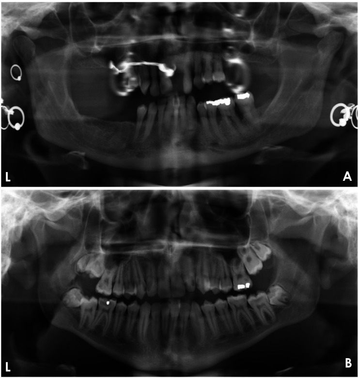 Automated quality evaluation of dental panoramic radiographs using deep learning.