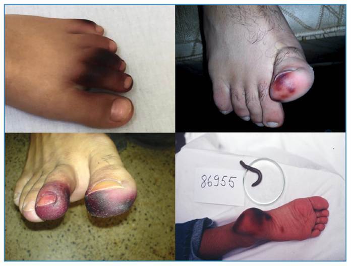 Myriapods (Diplopoda and Chilopoda): medical aspects of envenomations.