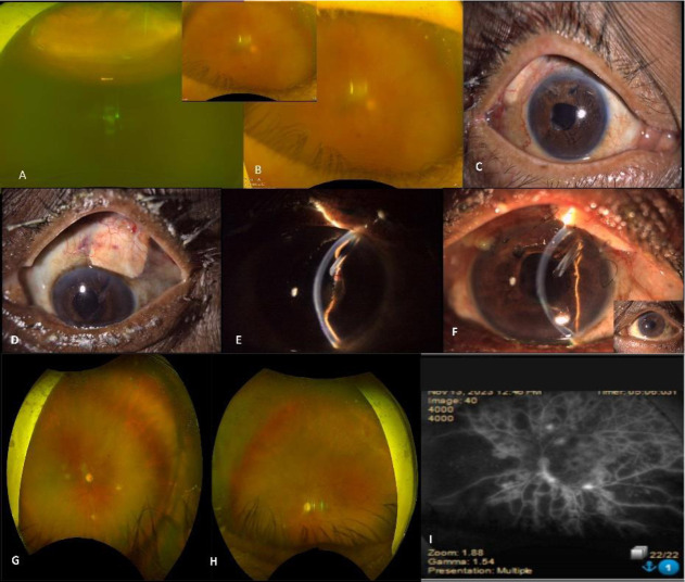 Clinical Challenges with Neovascular Glaucoma-Patient Tailored Strategies and Outcomes.