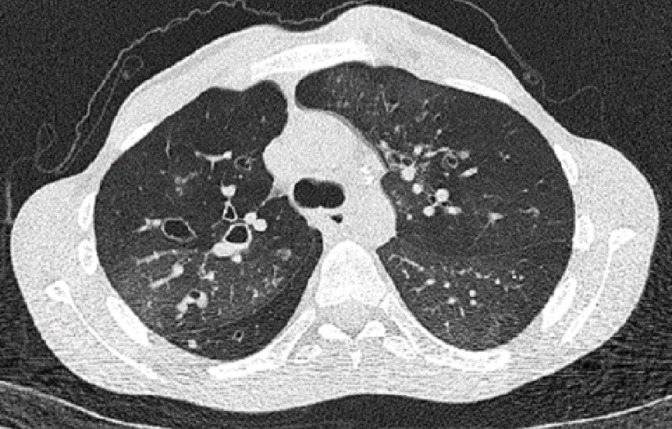 The Role of Pulmonary Genetic Variations in the Pathogenesis of Pediatric Postinfectious Bronchiolitis Obliterans.