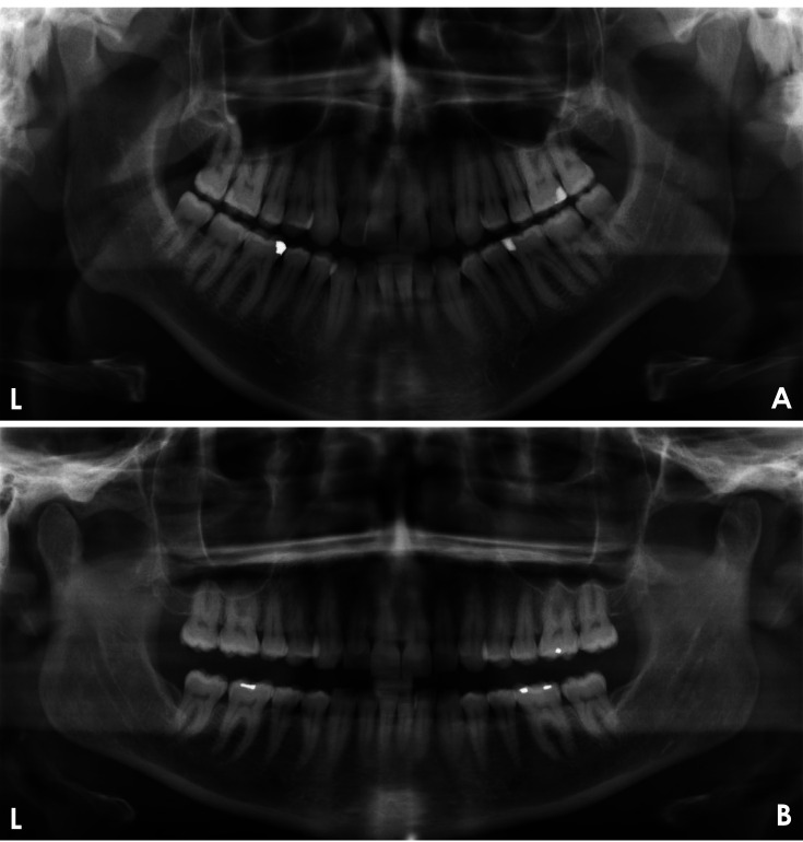 Automated quality evaluation of dental panoramic radiographs using deep learning.