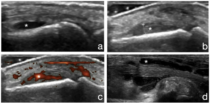 Ultrasound- and clinical-defined disease activities are associated with altered bone microarchitecture and lower bone mineral density in patients with rheumatoid arthritis.