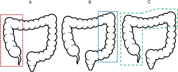 Right extended hemicolectomy with ileo-descending anastomosis is associated with prolonged postoperative ileus and longer hospital stay compared to right or left hemicolectomy.