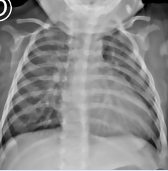 Percutaneous closure of aortopulmonary window using a muscular ventricular septal defect occluder. Instituto Nacional de Salud del Niño San Borja Lima-Peru. Case report.