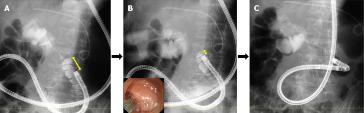 Practical guide to duodenal stenting for gastric outlet obstruction: Clinical outcomes, selection criteria, placement techniques, and management strategies.