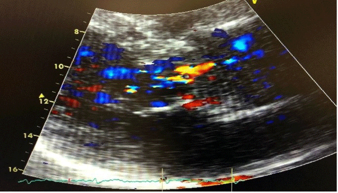 COVID-19 as Potential Cause of Aortic Valvulitis.
