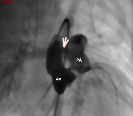 Percutaneous closure of aortopulmonary window using a muscular ventricular septal defect occluder. Instituto Nacional de Salud del Niño San Borja Lima-Peru. Case report.
