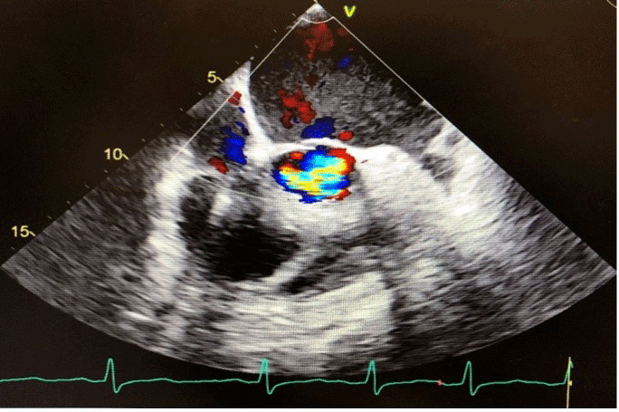COVID-19 as Potential Cause of Aortic Valvulitis.
