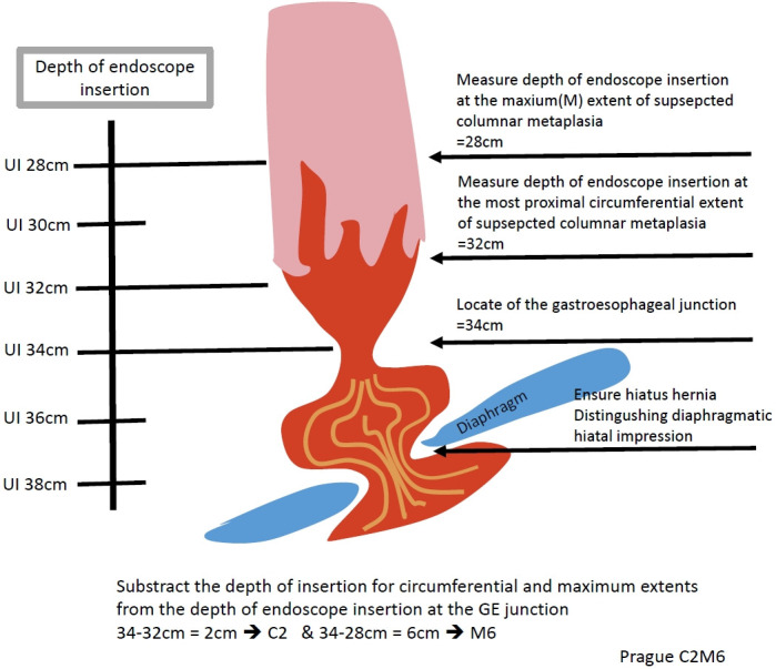 Barrett's Esophagus.