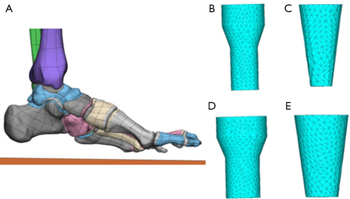 Effect of different subtalar joint arthroereisis implants on pediatric flexible flatfoot: a finite element analysis.