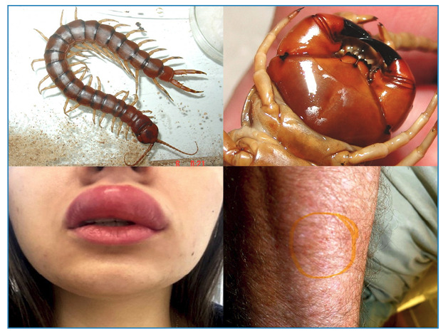Myriapods (Diplopoda and Chilopoda): medical aspects of envenomations.