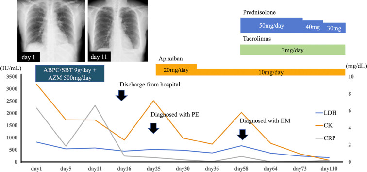 Anti-OJ Antibody-positive Antisynthetase Myopathy Diagnosed after Pulmonary Embolization.