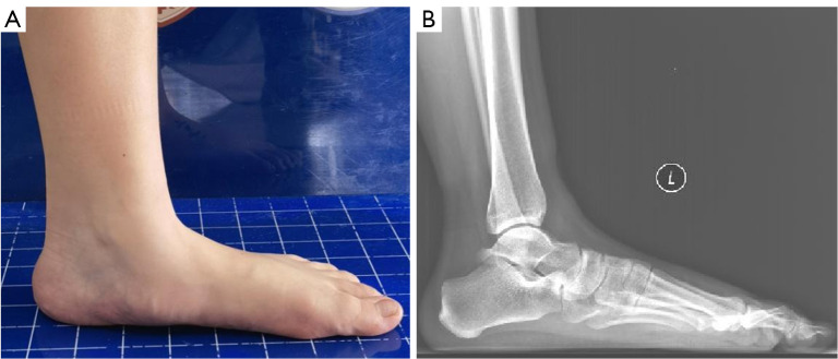 Effect of different subtalar joint arthroereisis implants on pediatric flexible flatfoot: a finite element analysis.