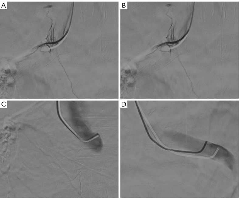 Primary aldosteronism patients with bilateral adrenal vein sampling success achieve better outcomes through unilateral adrenalectomy.