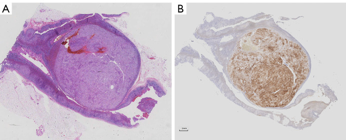 Primary aldosteronism patients with bilateral adrenal vein sampling success achieve better outcomes through unilateral adrenalectomy.