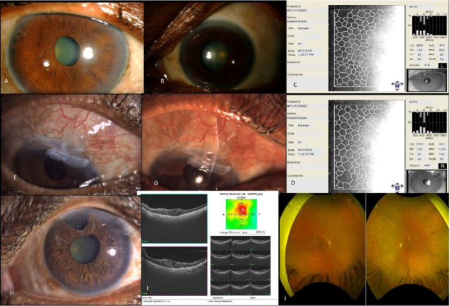 Clinical Challenges with Neovascular Glaucoma-Patient Tailored Strategies and Outcomes.
