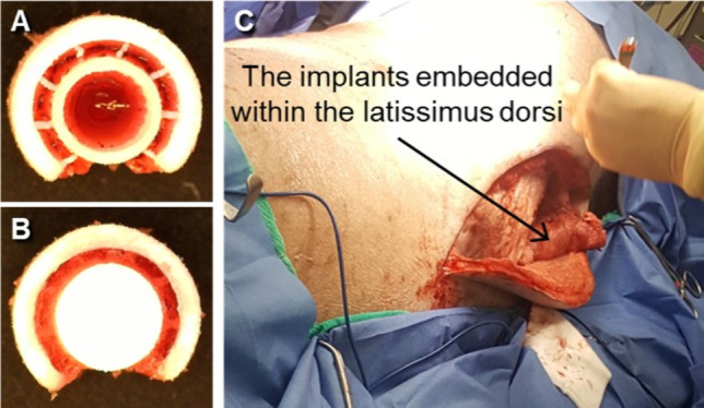 Feasibility Assessment of 3D Printing-Based Tubular Tissue Flap in a Porcine Model for Long Segmental Tracheal Reconstruction.