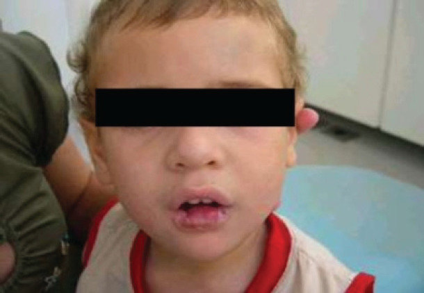 Lesch-Nyhan syndrome a dental approach: case report.