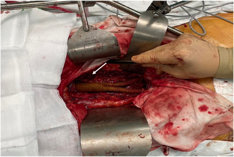 Unveiling Aortic Angiosarcoma: A Rare and Aggressive Vascular Malignancy in Vascular Oncology - A Case Report.