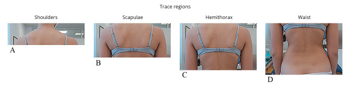 Association between trunk aesthetics and underling scoliosis severity and curve type in adolescents: evaluation of traditional clinical scores and novel automated indices from rasterstereographic imaging.