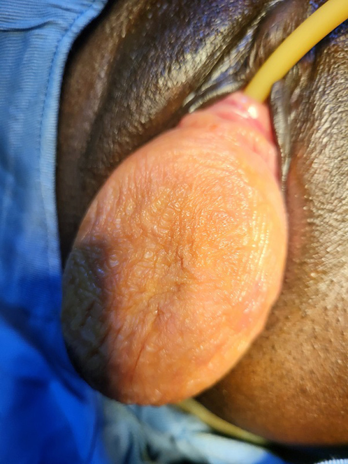 Clinical features and natural history of pelvic organ prolapse in South Kivu (Eastern DRC): a cross-sectional study.
