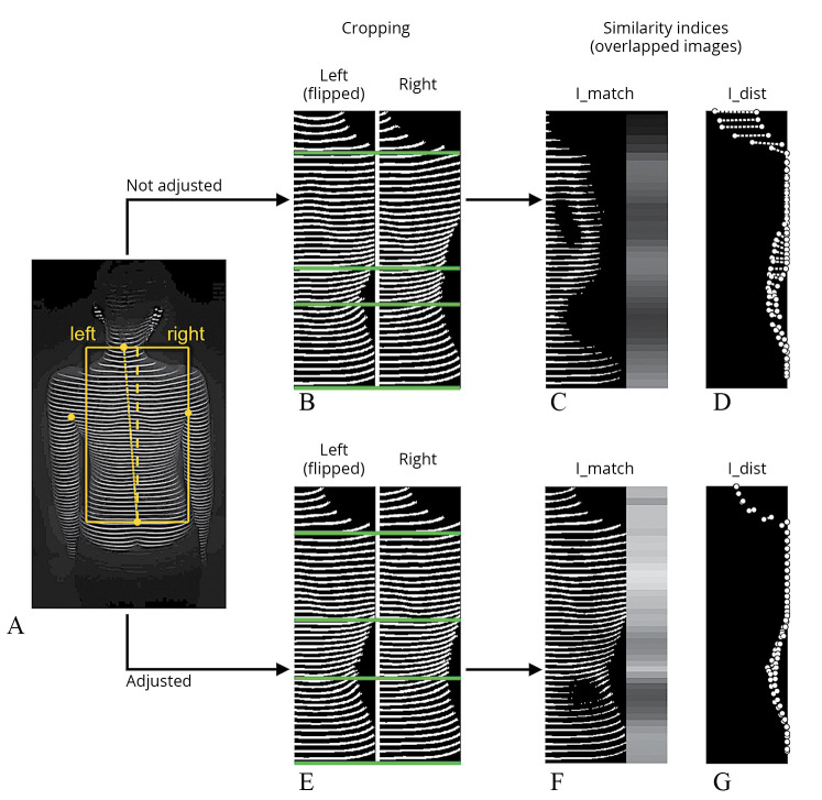 Association between trunk aesthetics and underling scoliosis severity and curve type in adolescents: evaluation of traditional clinical scores and novel automated indices from rasterstereographic imaging.