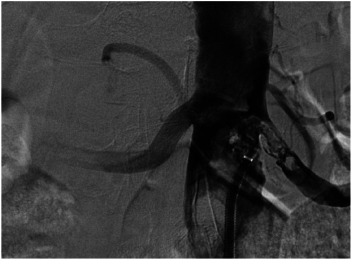 Unveiling Aortic Angiosarcoma: A Rare and Aggressive Vascular Malignancy in Vascular Oncology - A Case Report.