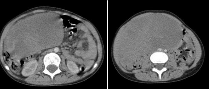 Ovarian relapse in a child with B-ALL: a case report.