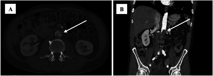 Unveiling Aortic Angiosarcoma: A Rare and Aggressive Vascular Malignancy in Vascular Oncology - A Case Report.