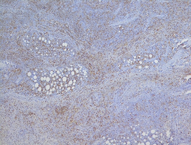 Ovarian relapse in a child with B-ALL: a case report.