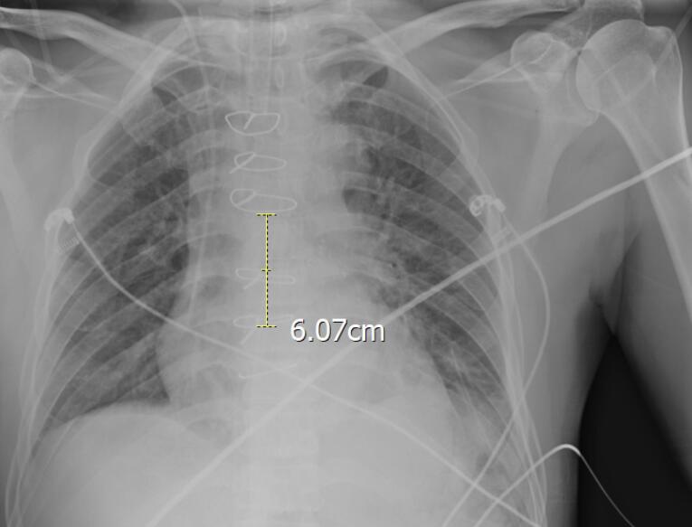 Is peres formula reliable for determination of proper position of central venous catheter tip in Iranian population?