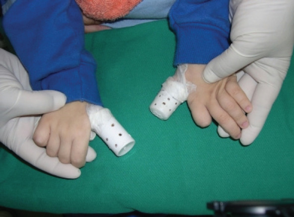 Lesch-Nyhan syndrome a dental approach: case report.