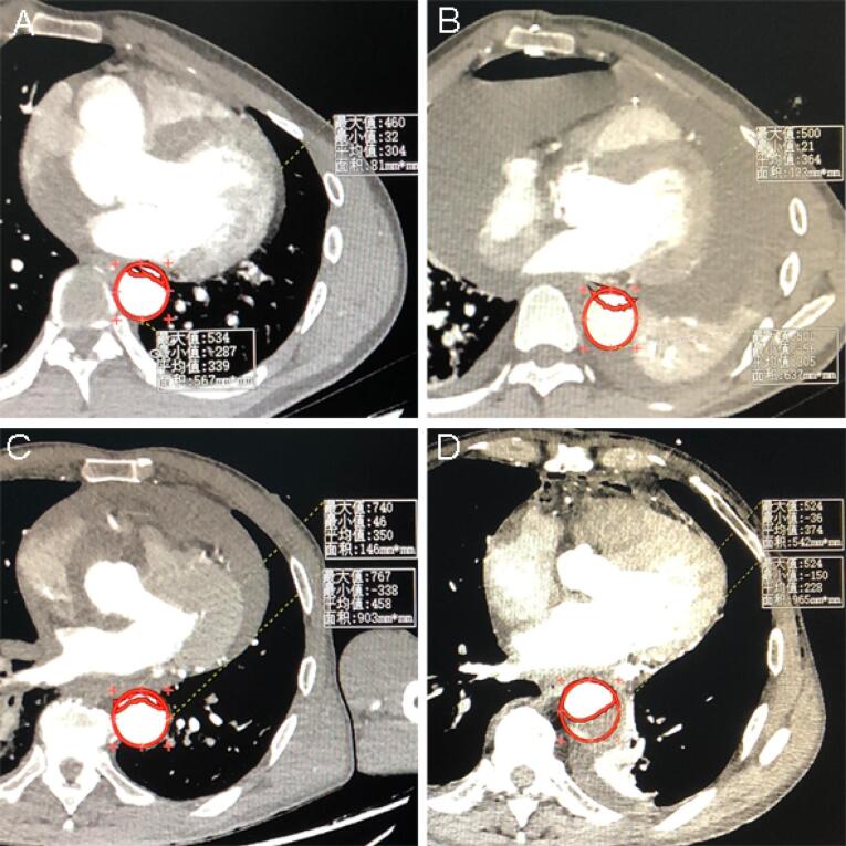 Reduction of maximal false lumen area ratio by interactive cannulation perfusion in DeBakey type I acute aortic dissection repair.