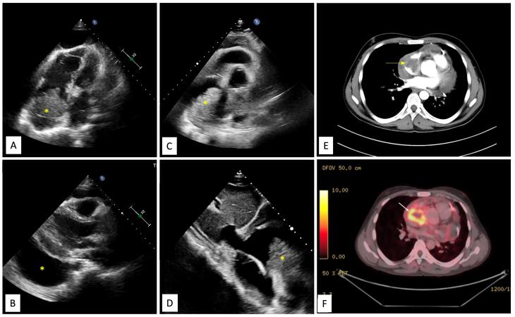 Primary cardiac angiosarcoma - a diagnostic roller-coaster till fatality.