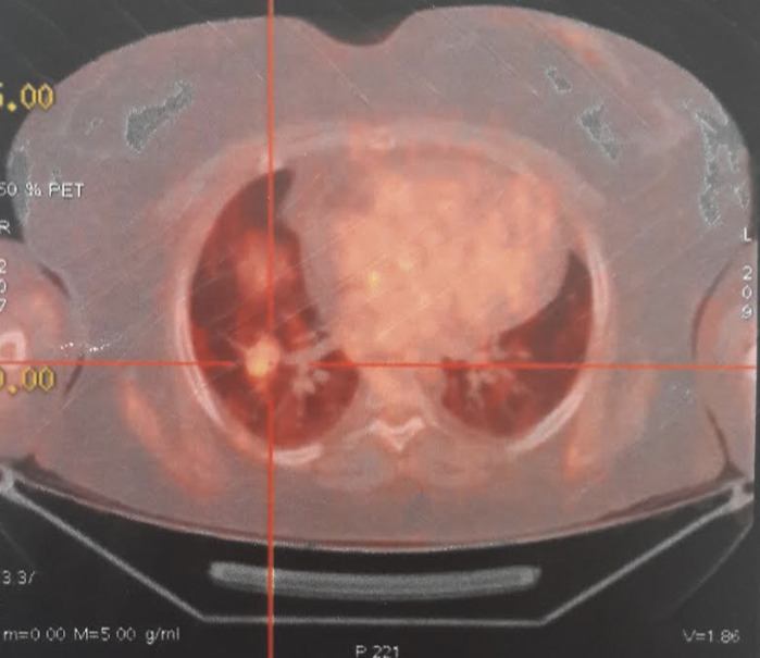 [A case report of paraneoplastic Cushing's syndrome in young adults: a rare entity and real diagnostic challenge].