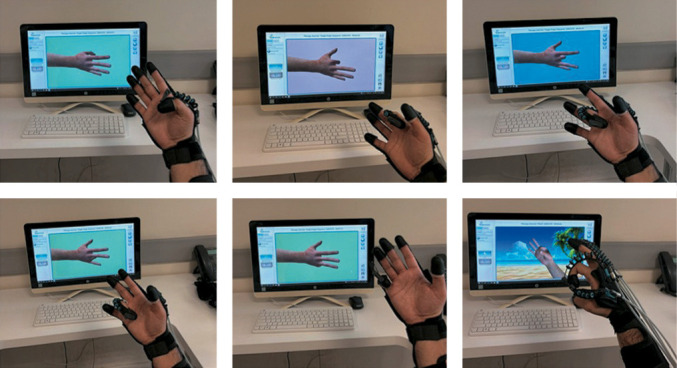 Individual and combined applied robotic hand rehabilitation and conventional rehabilitation for post-stroke hemiplegia: a prospective three-arm randomized study.