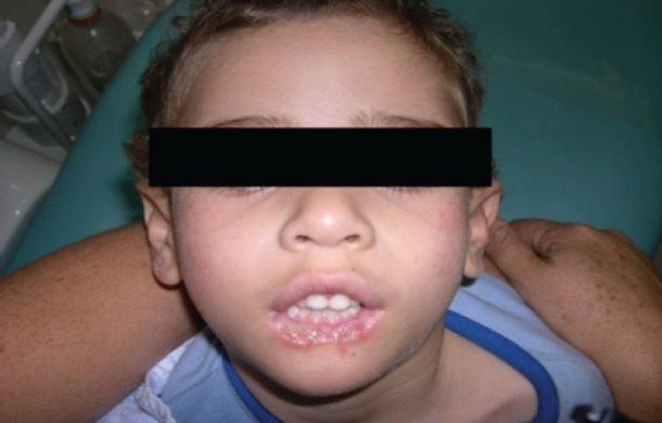 Lesch-Nyhan syndrome a dental approach: case report.