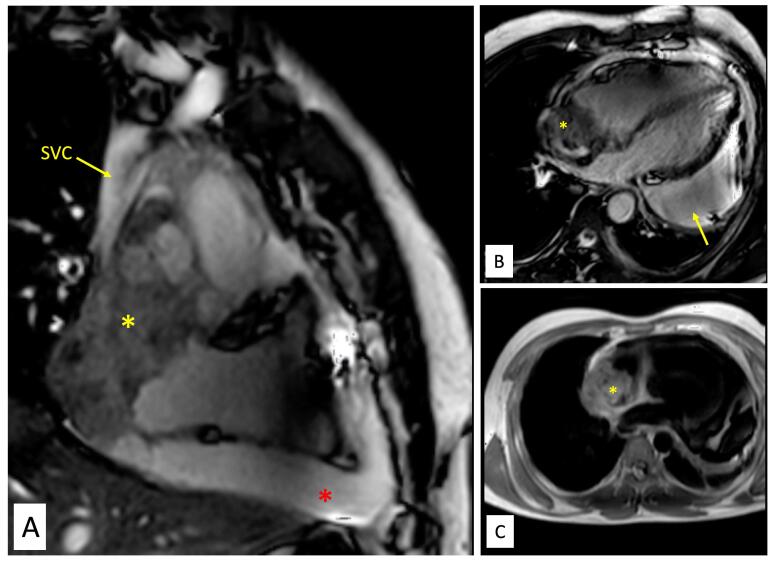 Primary cardiac angiosarcoma - a diagnostic roller-coaster till fatality.