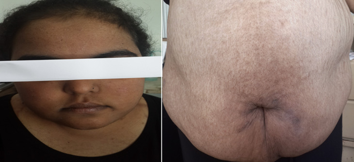 [A case report of paraneoplastic Cushing's syndrome in young adults: a rare entity and real diagnostic challenge].