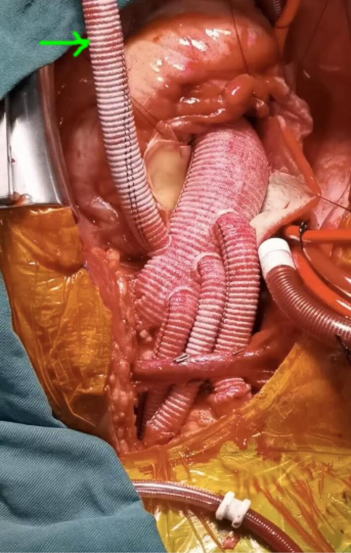 Reduction of maximal false lumen area ratio by interactive cannulation perfusion in DeBakey type I acute aortic dissection repair.