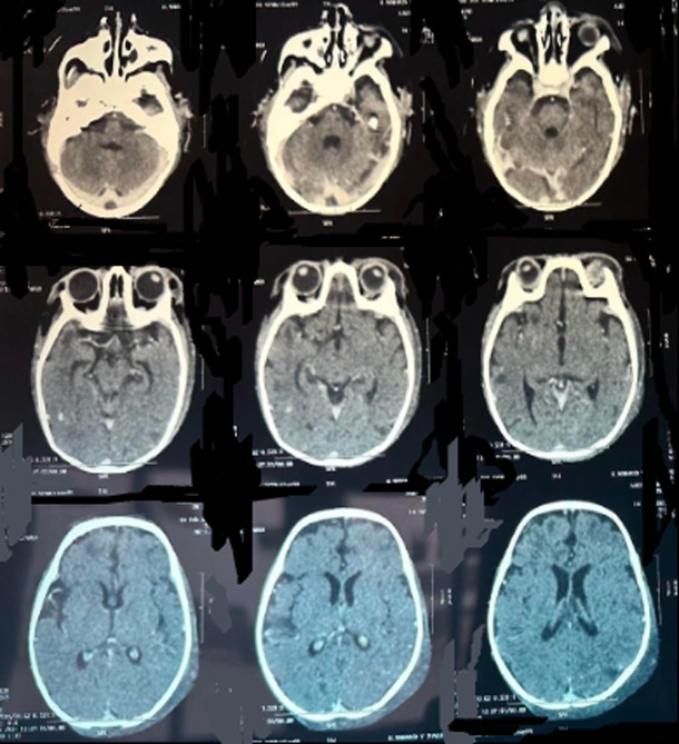 Diagnostic and therapeutic challenges of a heparin-induced thrombocytopenia in HIV immunodeficiency: in regards to a pediatric case (a case report).